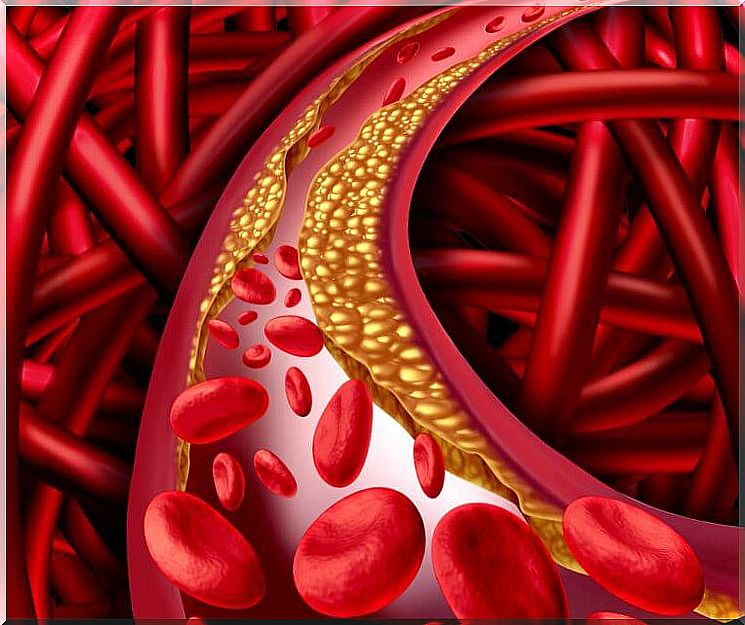 LDL cholesterol in the arteries