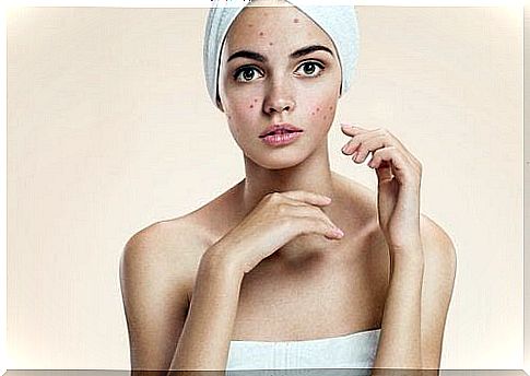 Mask against acne with baking soda and honey