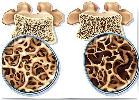 Calcium-rich natural remedies for the prevention of osteoporosis