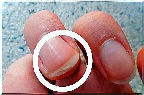 Cracked and Chipping Nails - Causes, Treatments, and Solutions