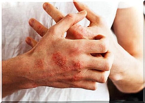 Diet for psoriasis: various recommendations