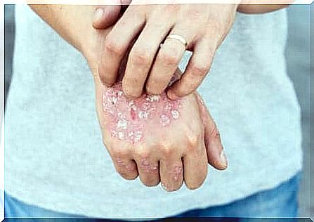 psoriasis 