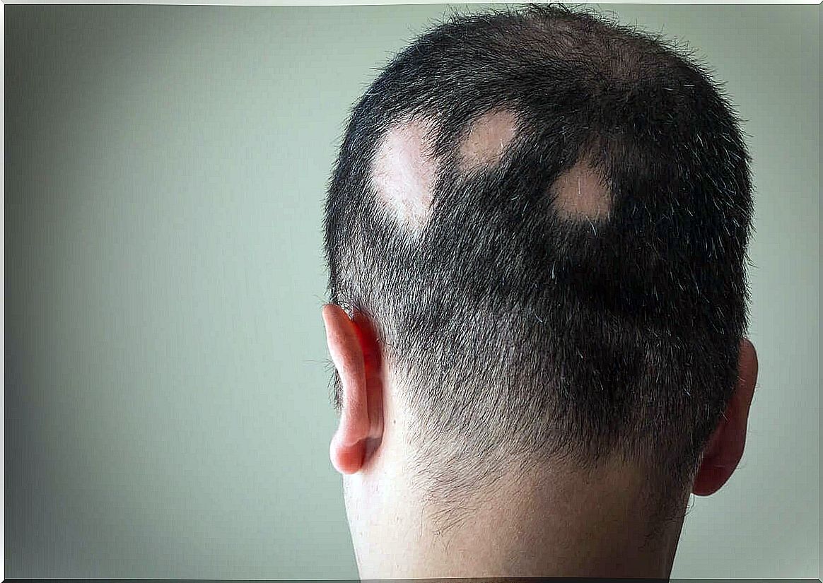 Man with alopecia