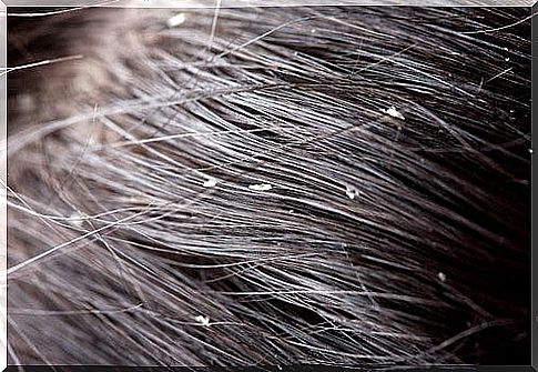 Effective home remedies for dandruff