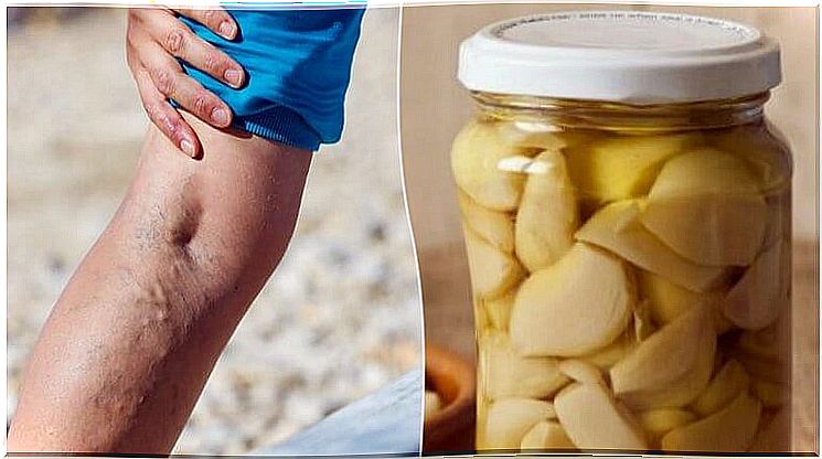 Garlic-lemon ointment for varicose veins