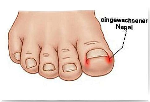 Ingrown nail