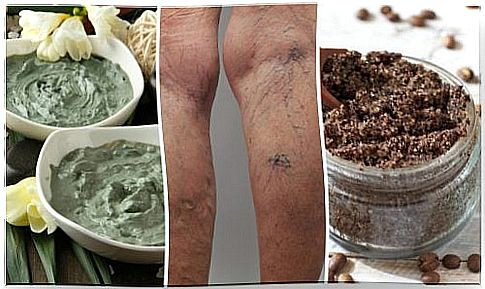 How to naturally prevent varicose veins with 6 home remedies