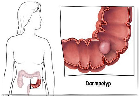 Interesting facts about intestinal polyps