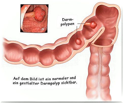 intestinal polyps 1