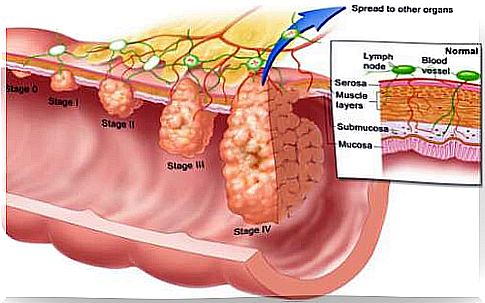 intestinal polyps