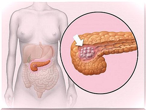 Pancreatic cancer is said to be the second deadliest cancer