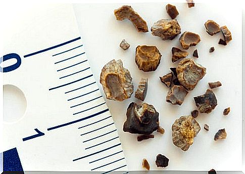 Kidney stones_small