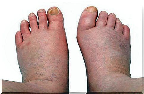 Swollen ankles and feet: 6 natural home remedies