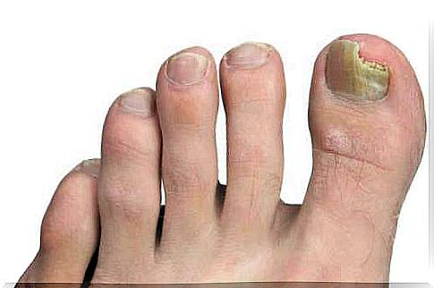 Tips against nail fungus