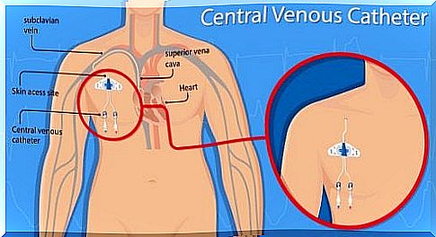 Vascular perforation through a central venous catheter