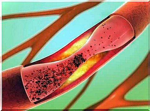 Risk of vascular perforation from a central venous catheter