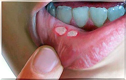 What to do with sores in the mouth  Helpful natural remedies